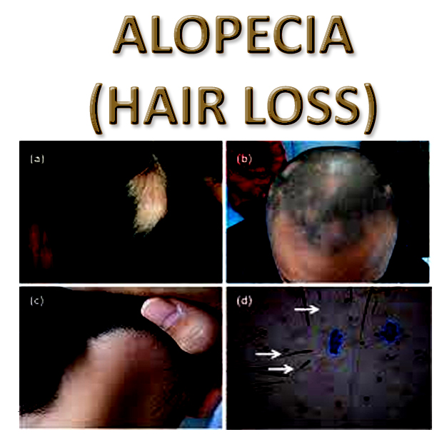 Alopecia (Hair Loss)