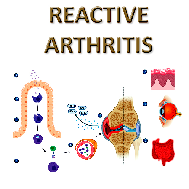 Reactive Arthritis